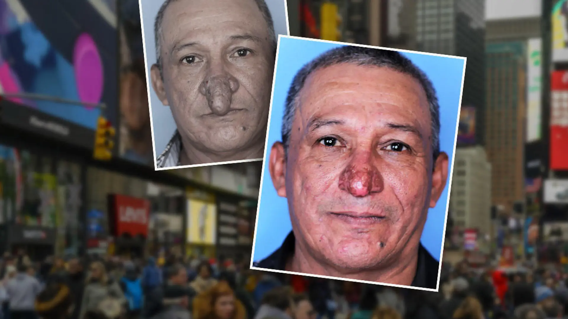 Mann mit "Penis"-Nase hat endlich Nasen-OP bekommen