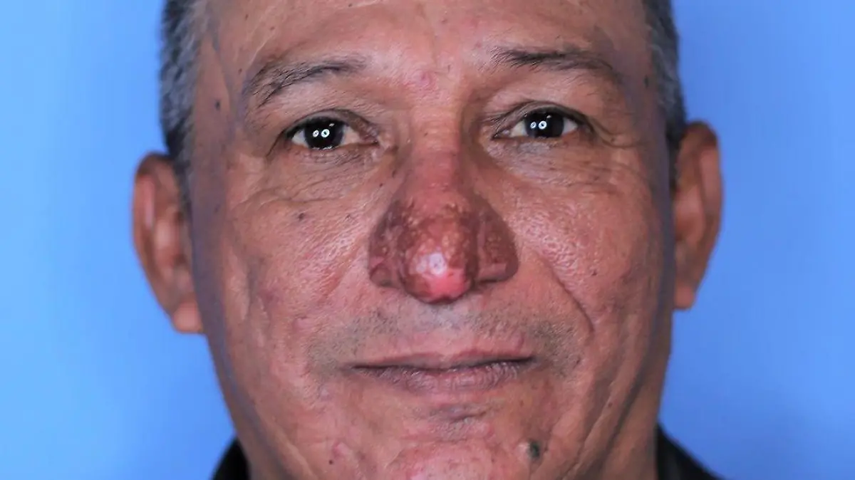 Jahrelang litt Conrado Estrada an seiner "Penis"-Nase. Nun ist er operiert