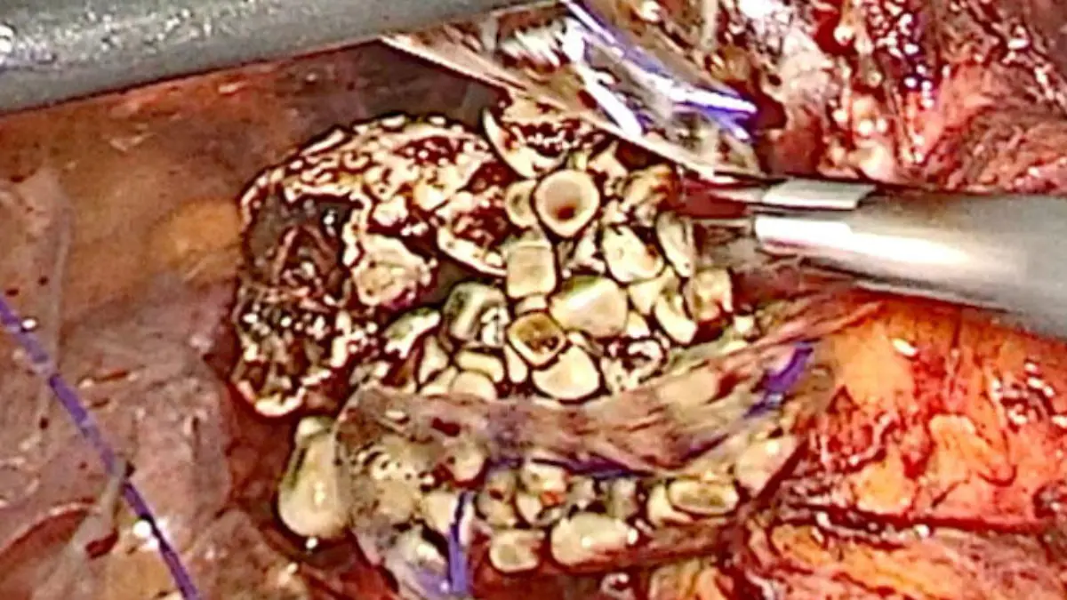 Die Ärzte trauen Ihren Augen nicht: Die Steine befanden sich im Magen und nicht in den Harnleitern.