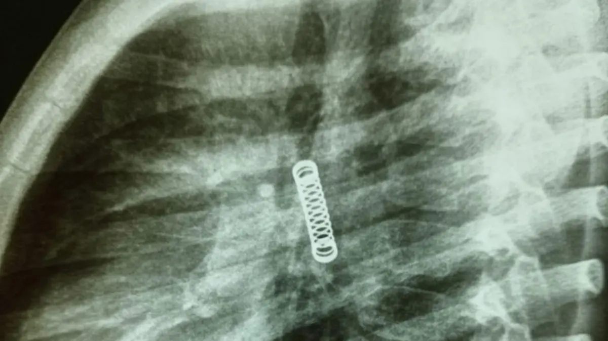 Story from Jam Press (Spring In Lung)

Pictured: An x-ray of the boy showing the spring.

Boy, five, had metal spring in his lung for THREE MONTHS.

A five-year-old boy had a metal spring removed from his lung after it was stuck there for THREE MONTHS.

The youngster had been suffering from a bad cough since December before being taken to the doctors.

While carrying out extensive checks to look for a potential cause, doctors were stunned to find a metal object in his left lung.

The spring showed up in X-rays.

The unnamed boy was first treated at the Hospital Regional De Villarrica, Guairá Department, in Paraguay.

He was transferred to the National Institute of Respiratory and Environmental Diseases for urgent treatment.

The boy is said to be in a stable condition after medics successfully removed the metal spring the following morning on 8 March.

Dr Carlos Morinigo said the procedure was complicated due to the time the foreign object had been lodged in the boy’s lung as well as the damage it had caused during that period.

However, despite causing a “probable decrease” in the lung’s capacity, Dr Morinigo said it will likely improve as the lad grows over time.

The INERAM doctor posted images of the boy’s procedure on social media with the message: “Three months of coughing.

“Never been taken to the doctor before. Poor little thing.”

He also reminded parents to take extra care around young children, adding that they should always take them to see a doctor if they are suffering from a persistent problem.

Earlier this month, a 17-year-old girl had a pellet removed from her skull after being shot on her way to a gym class in Tías, Lanzarote, Spain.

At the clinic, the attending physician noticed two puncture wounds in the patient’s head and a suspected foreign object embedded in one of them.

After X-ray and CT scans confirmed the presence of the foreign object and the extent of the injury, doctors successfully removed the item without incid