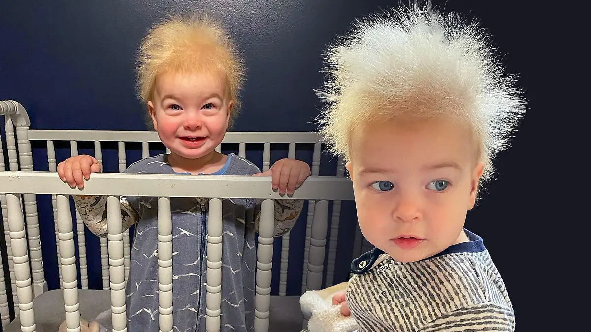 Der einjährige Locklan aus Georgia (USA) leidet am "Struwwelpeter-Syndrom".
