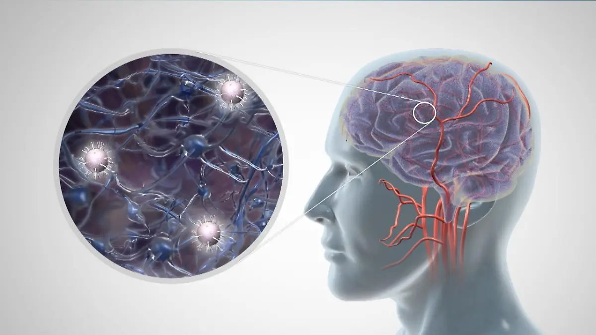 Das passiert bei Alzheimer im Gehirn Unheilbar und zerstörerisch