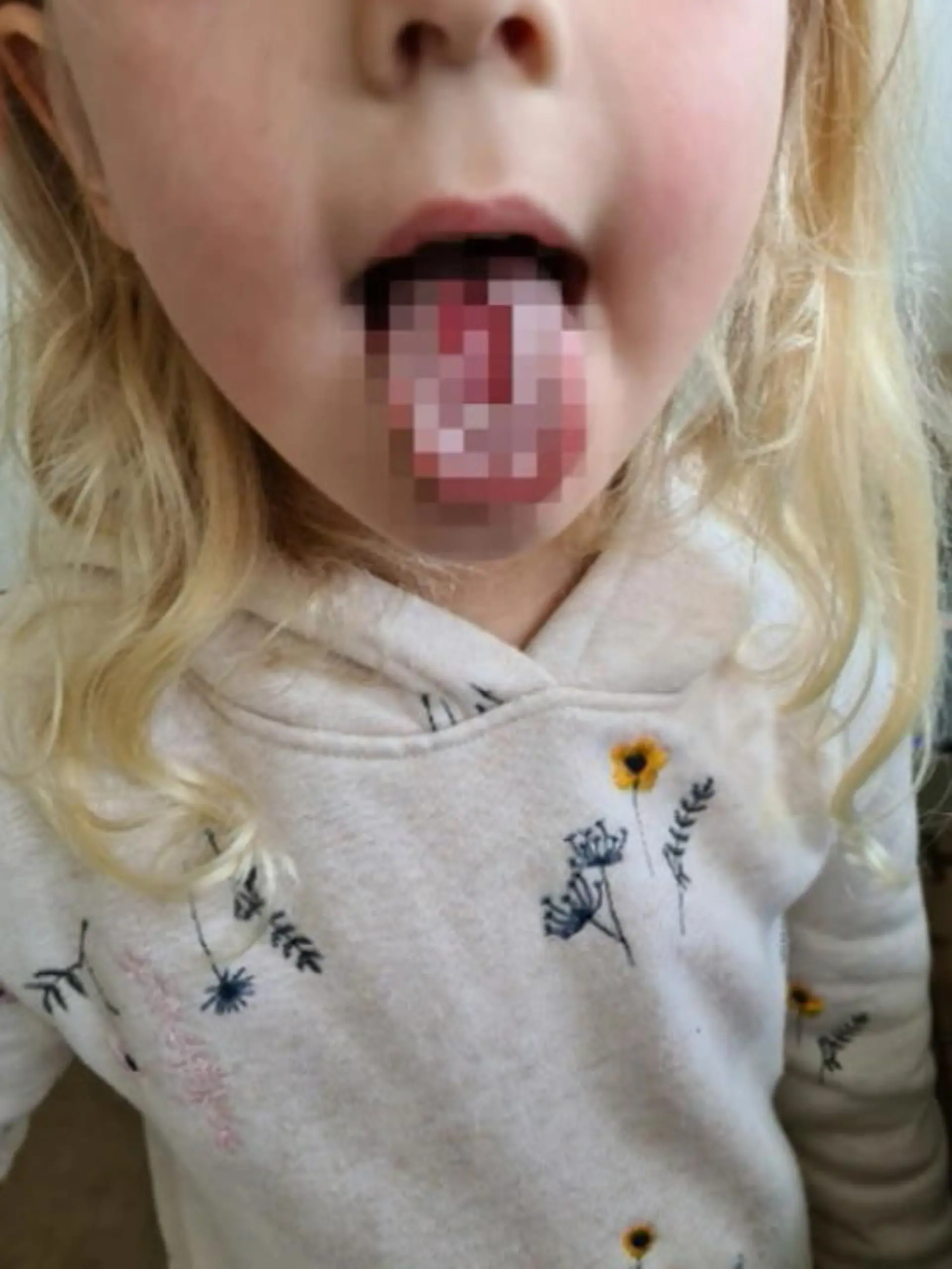 Dass sauer nicht nur lustig macht, sondern auch echt gefährlich sein kann, musste die 4-Jährige Willow am eigenen Leib erfahren! Sie hat eine riesen Brandblase auf ihrer Zunge und das offenbar durch SAURE Bonbons. Wie kann das sein?