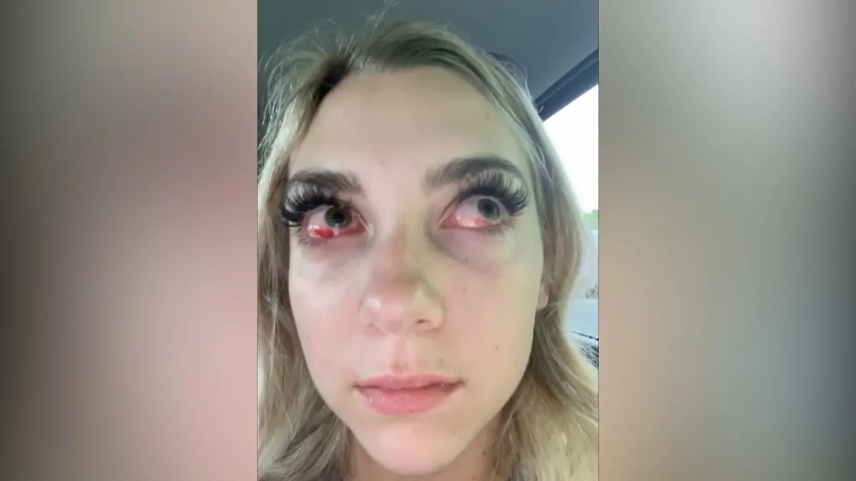 Allergische Reaktion!: Nach Wimpernverlngerung: 17-Jhrige sieht aus wie  Zombie!