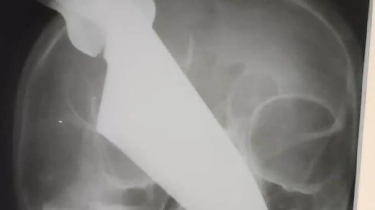 Frau mit Messer in Nase Russland