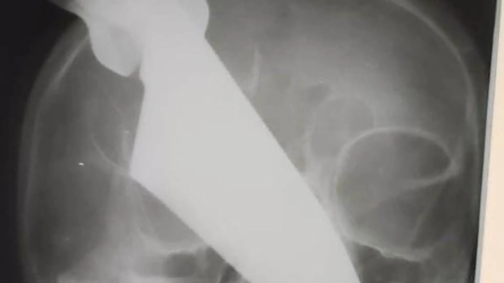 Frau mit Messer in Nase Russland