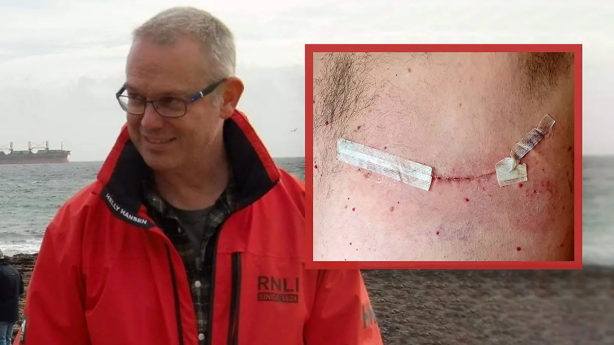 Eine alte Rugby-Verletzung bei Angus McKay entpuppt sich 30 Jahre später als Brustkrebs.