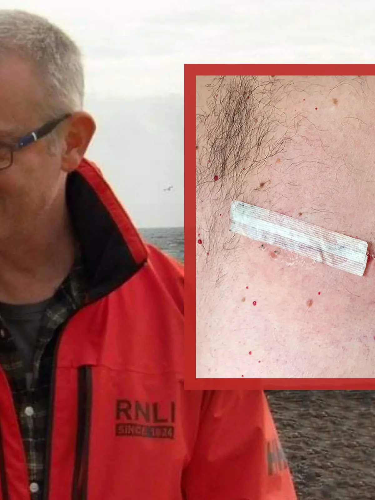 Eine alte Rugby-Verletzung bei Angus McKay entpuppt sich 30 Jahre später als Brustkrebs.