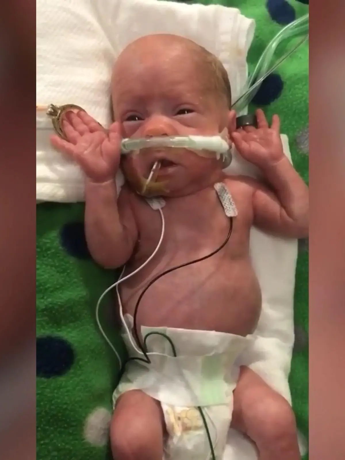 Die Ärzte haben Kaio eine Überlebenschance von gerade einmal zehn Prozent gegeben. Umso erstaunlicher ist es, dass der kleine Junge aus Amerika überlebt hat!