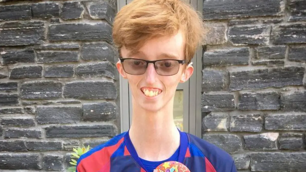 Dylan Lombard / CATERS NEWS - (PICTURED Dylan ) A Scottish teenager has opened up about his life with an ultra rare condition - which affects just 13 people worldwide - as his body is unable to store fat. Dylan Lombard, 18, from Glasgow, Scotland, was diagnosed with MDP -  Mandibular Hypoplasia, with Deafness and Progeroid Features - when he was 18 months old. The condition - which affects just one in six-hundred-million people worldwide - prevents fatty tissue from being stored underneath the skin, and results in a small lower jaw, ears, deafness and tightening of the skin. Dylan said: "I was born with this condition, but it did not become visible until I was 18 months old.SEE CATERS COPY