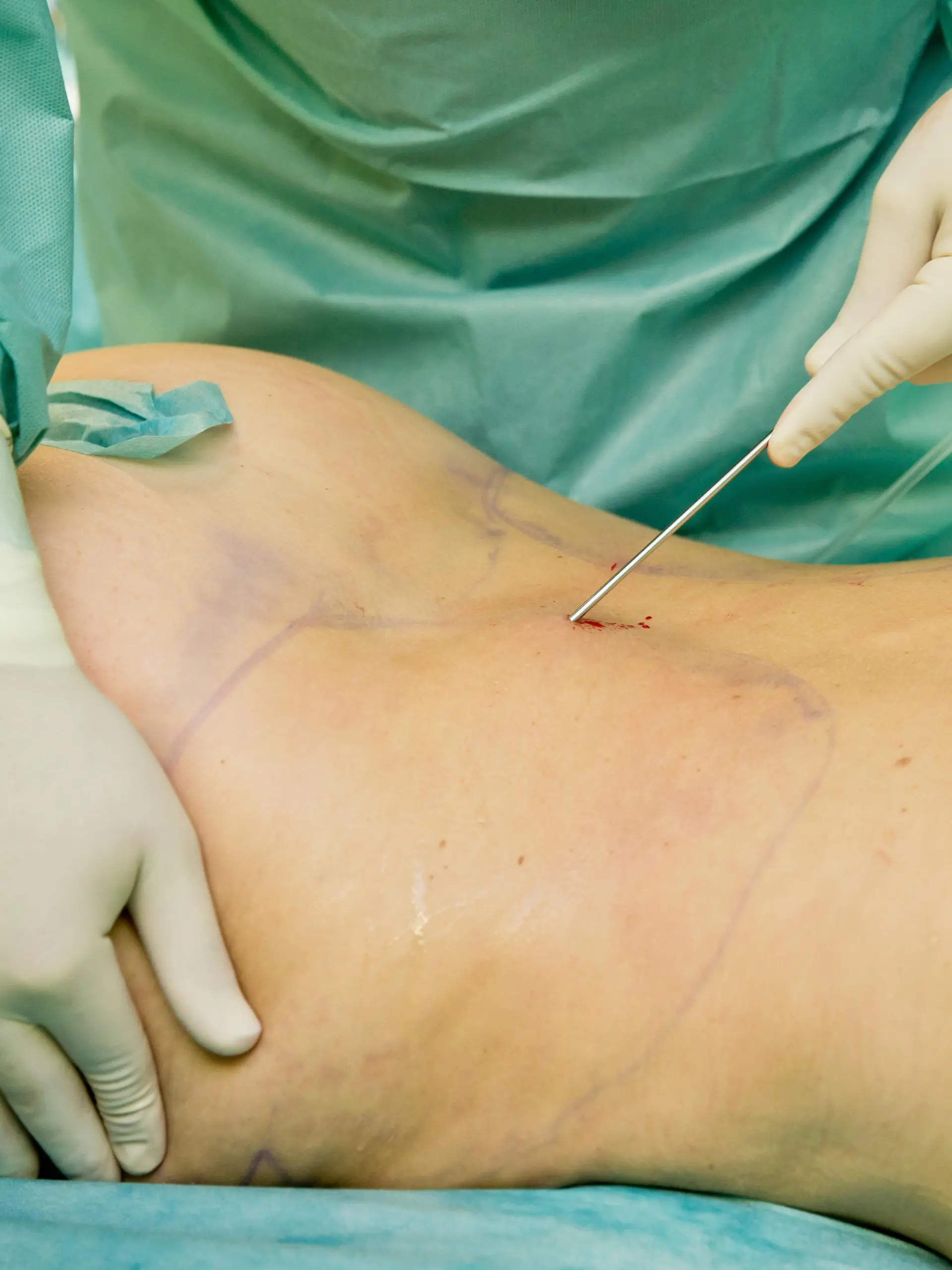 Ein Facharzt fuer plastisch-aesthetische Chirurgie fuehrt am 20.10.2015 an der Klinik fuer Aesthetisch-Plastische Chirurgie in Nuernberg (Bayern) bei einer anaesthesierten Patientin eine Fettabsaugung an den Hueften durch. Hierbei loest er im Vorfeld mit einer Ultraschallsonde das Fett um anschliessend ein besseres Ergebnis beim Absaugen zu erzielen. Foto: Daniel Karmann