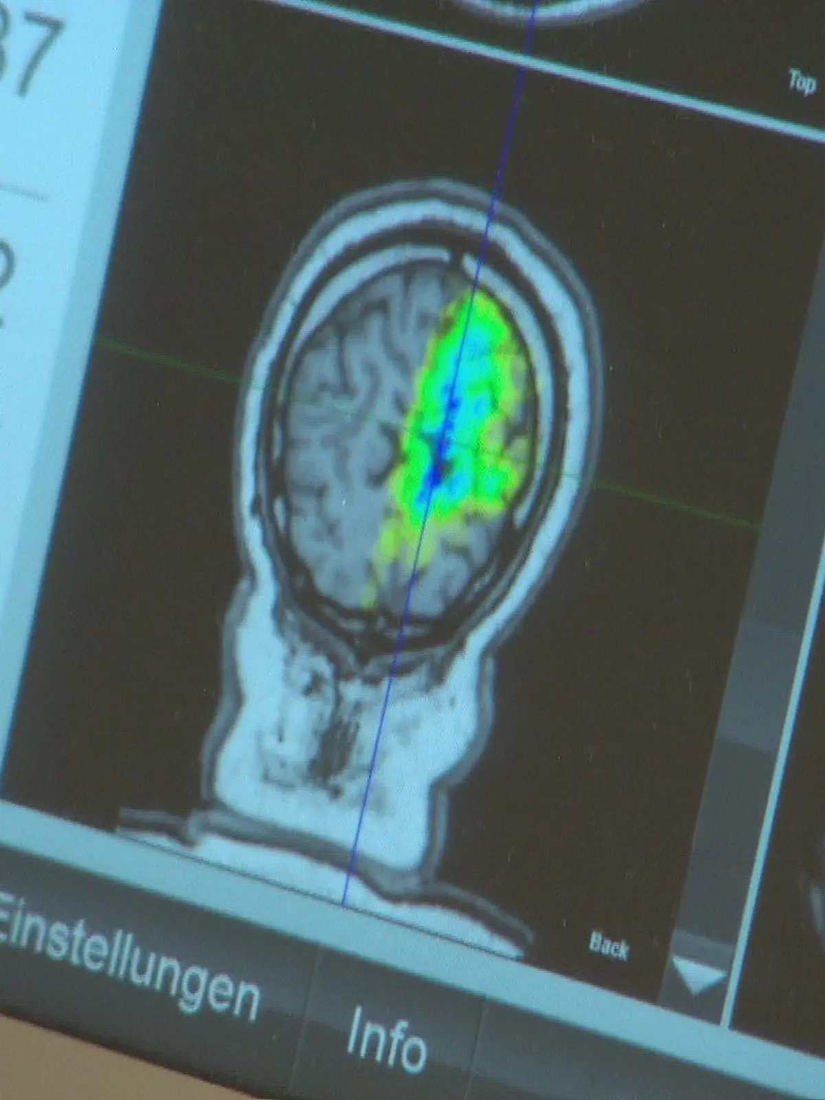Die Stoßwellentherapie soll Nervenzellen gezielt aktivieren und die Hirnfunktionen verbessern