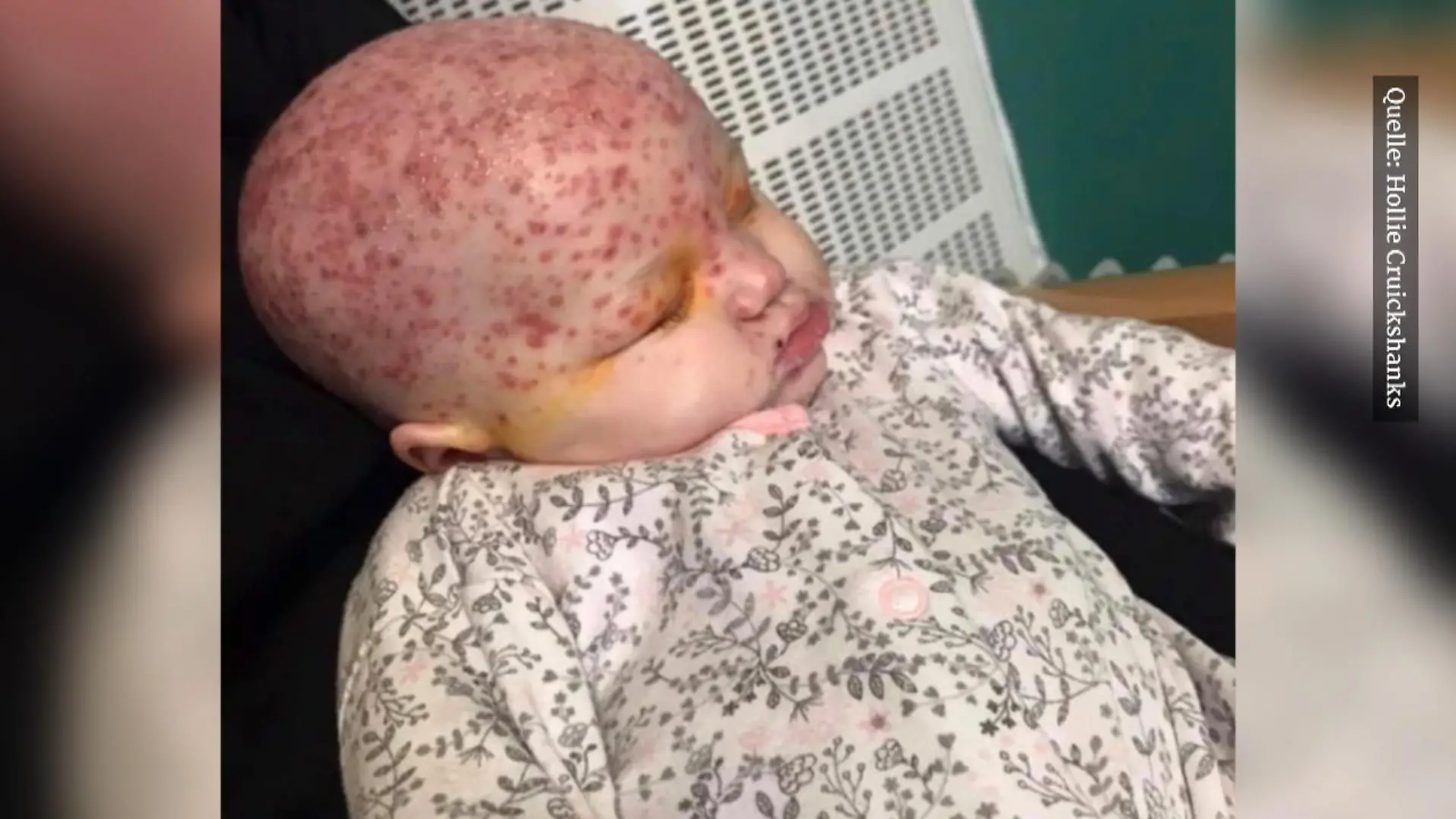 Baby hat Herpesinfektion am ganzen Körper Nach Kuss von Mutter fast erblindet