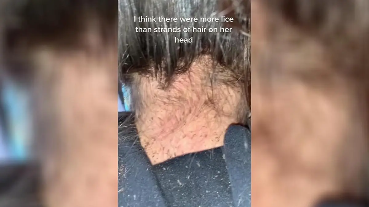 Der ganze Kopf ist voller Läuse