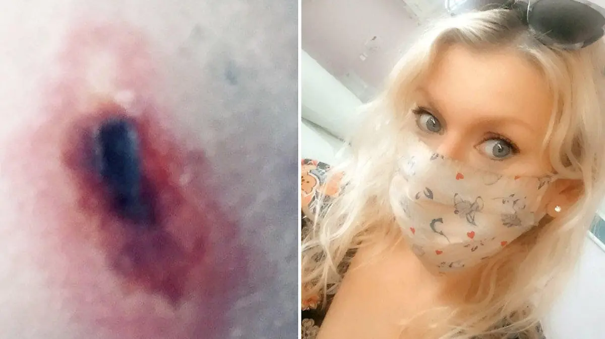 SONDERKONDITIONEN: Satzpreis!
Sepsis nach Spinnenbiss: Die 34-jährige Jo Kenyon musste im Krankenhaus behandelt werden -- COMPOSITE PICTURE - Jo Kenyon (R) & the spider bite (L). A woman was hospitalised three times after she was bitten by a spider lurking under the loo seat. See SWNS story SWSYbite. Jo Kenyon, 34, was sat on the toilet when the insect - thought to be a false widow - scurried out and sunk its fangs into her thigh. She flushed it down the pan and called 111 where medics told her to rush to hospital over fears it get infected. Doctors had to pop the huge blister which formed under the fang marks - and the radio producer was forced to twice return to A&E to have the mass drained. The bite mark was so painful she could barely walk, and doctors feared it might result in lie-threatening sepsis.
/ action press