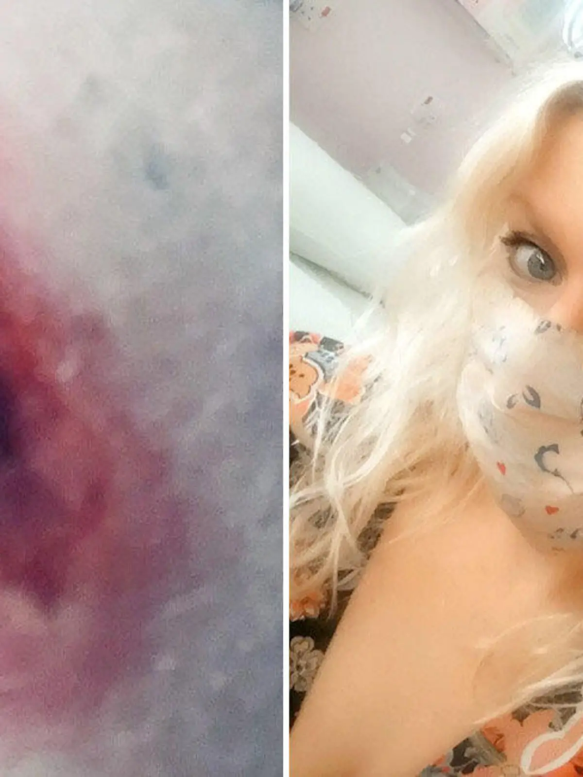 SONDERKONDITIONEN: Satzpreis!
Sepsis nach Spinnenbiss: Die 34-jährige Jo Kenyon musste im Krankenhaus behandelt werden  --   COMPOSITE PICTURE - Jo Kenyon (R) & the spider bite (L).  A woman was hospitalised three times after she was bitten by a spider lurking under the loo seat.  See SWNS story SWSYbite.  Jo Kenyon, 34, was sat on the toilet when the insect - thought to be a false widow - scurried out and sunk its fangs into her thigh.  She flushed it down the pan and called 111 where medics told her to rush to hospital over fears it get infected.  Doctors had to pop the huge blister which formed under the fang marks - and the radio producer was forced to twice return to A&E to have the mass drained.  The bite mark was so painful she could barely walk, and doctors feared it might result in lie-threatening sepsis. 

  / action press