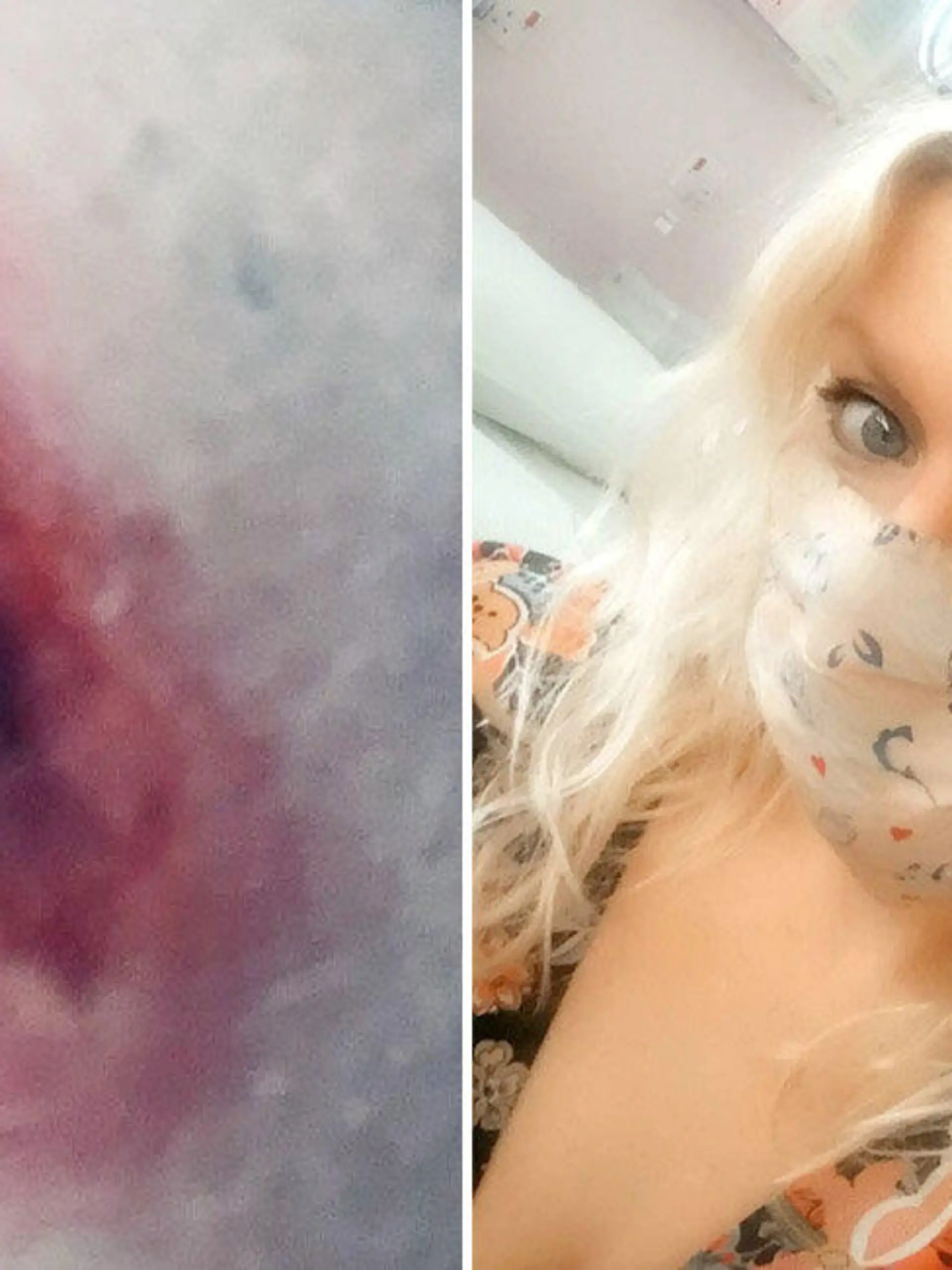 SONDERKONDITIONEN: Satzpreis!
Sepsis nach Spinnenbiss: Die 34-jährige Jo Kenyon musste im Krankenhaus behandelt werden  --   COMPOSITE PICTURE - Jo Kenyon (R) & the spider bite (L).  A woman was hospitalised three times after she was bitten by a spider lurking under the loo seat.  See SWNS story SWSYbite.  Jo Kenyon, 34, was sat on the toilet when the insect - thought to be a false widow - scurried out and sunk its fangs into her thigh.  She flushed it down the pan and called 111 where medics told her to rush to hospital over fears it get infected.  Doctors had to pop the huge blister which formed under the fang marks - and the radio producer was forced to twice return to A&E to have the mass drained.  The bite mark was so painful she could barely walk, and doctors feared it might result in lie-threatening sepsis. 

  / action press