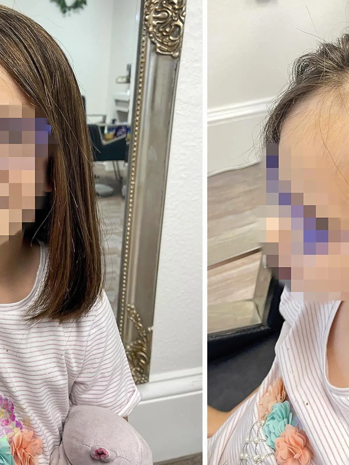 Nach einem Unfall in der Küche hat das Mädchen teilweise keine Haare mehr.