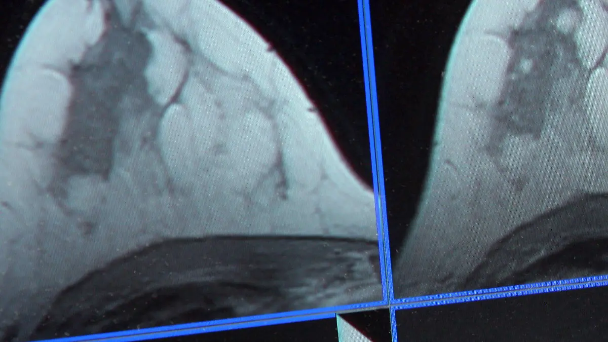 ARCHIV - Auf der Bildschirmdarstellung einer Magnetresonanz-(MR)-Mammographie ist am 04.07.2007 ein winziger Tumor in der Brust einer Patientin zu sehen. (zu dpa "Krebsbericht: Deutlich mehr Neuerkrankungen - aber auch Positives" vom 29.11.2016) +++(c) dpa - Bildfunk+++