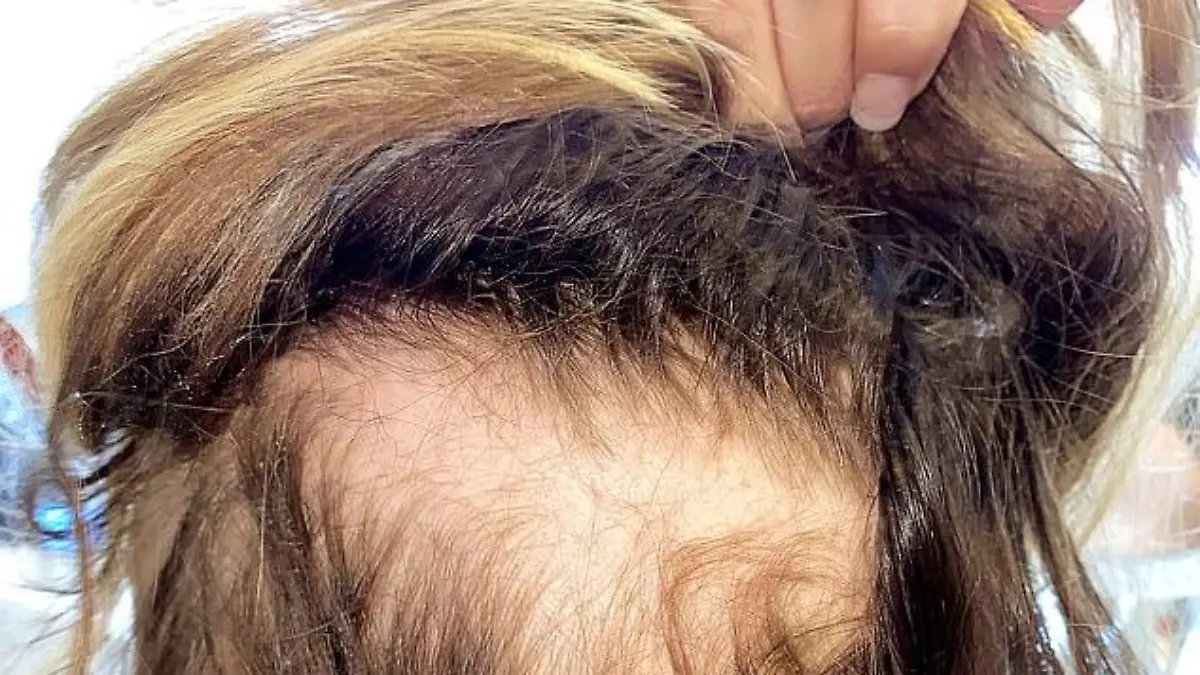 ZaraLena Jacksons Haare fallen büschelweise aus, später erhält der Reality-Star die Diagnose Alopezie