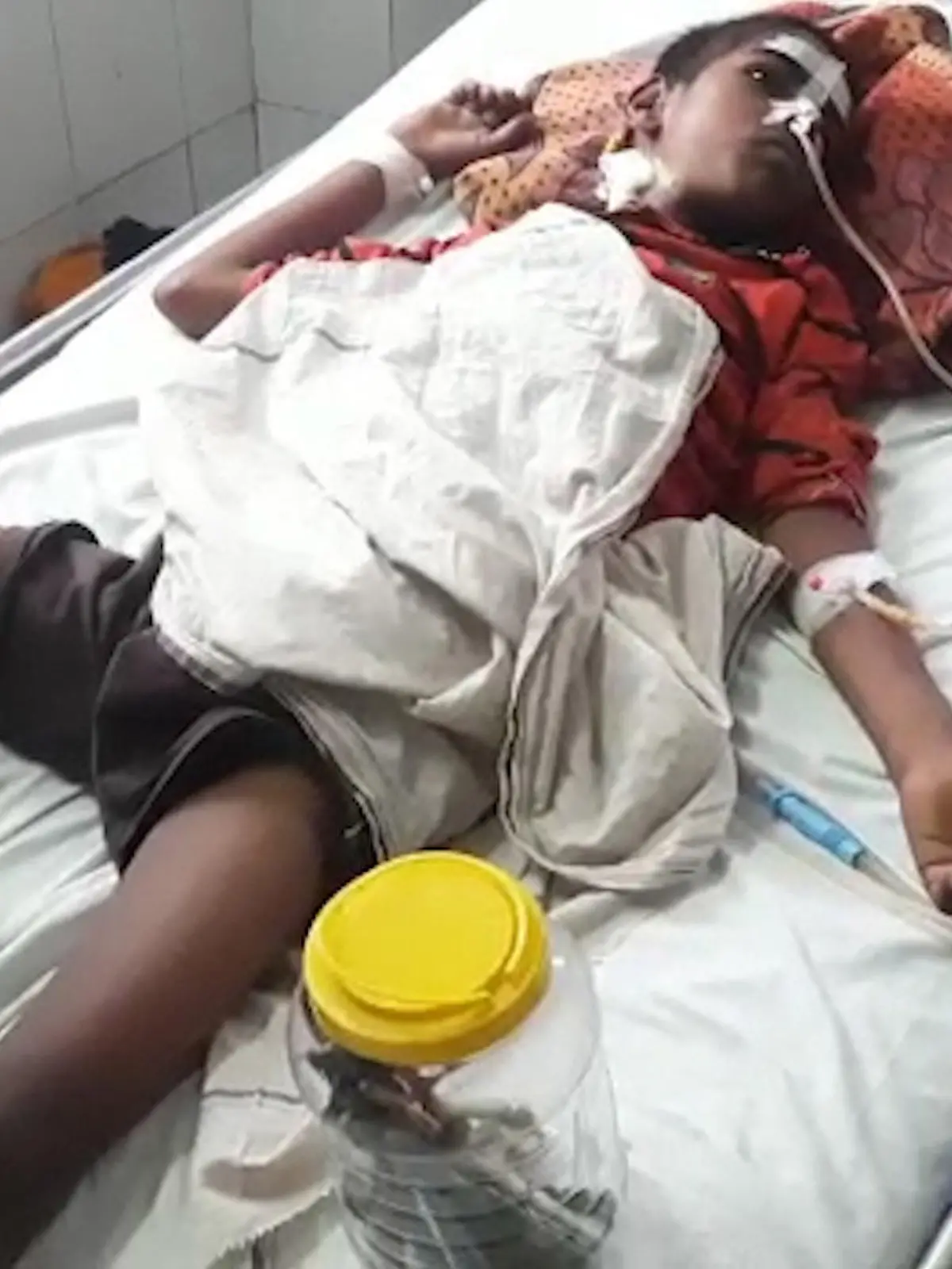 Story from Jam Press (Toothbrushes Stomach)

Pictured: Harish Devi in hospital after the surgery to remove the toothbrushes and nail from his stomach.

Doctors remove 16 TOOTHBRUSHES and IRON NAIL from boy’s STOMACH.

***Warning – graphic photos and videos***

Doctors in India have managed to successfully remove 16 toothbrushes and a three-inch iron nail from a teenage boy’s stomach.

Prior to the surgery, Harish Devi, 14, from the state of Uttar Pradesh, India, had ingested the dental equipment after being advised to by a holistic practitioner saying it would cure his habit of eating soil.

His family also believed Harish had been possessed by a ghost and that consuming toothbrushes and nails would help heal him.

After feeding him the plastic items and metal nail, his family discovered his habit of eating dirt did not go away but the teenager started experiencing pain in his abdomen.

Harish was taken to Baba Raghav Das Medical College, where they discovered he had toothbrushes and a nail in his stomach.

Doctors operated on the 14-year-old and took out 16 toothbrushes and a three-inch nail from his insides.

Following the removal of the foreign objects, Harish’s health has improved and doctors are hopeful he will make a full recovery.

The gruesome photos show snippets from the surgery with some of the toothbrushes being removed from the patient’s stomach.

In the video, one doctor holds up an X-ray to show the large iron nail in the middle of the youngster's body.

Harish can be seen recovering from his surgery on a bed with a box of the toothbrushes taken from his stomach by his side.

ENDS