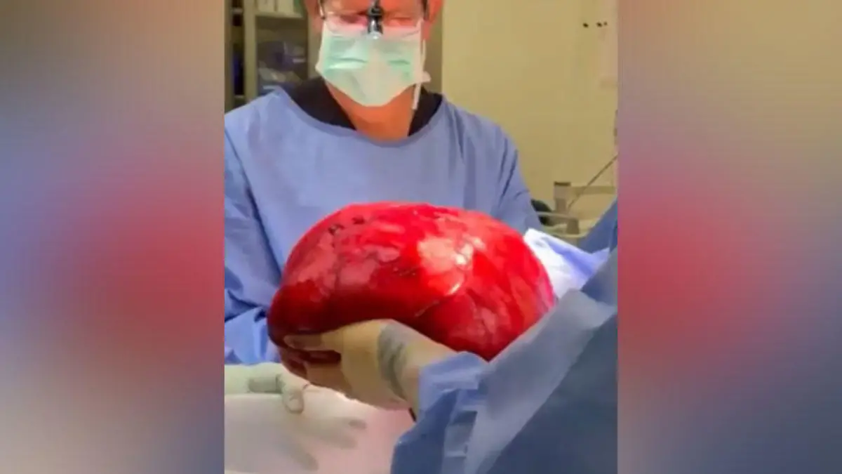 Glücklicherweise hatte der Krebs nicht gestreut. Aber der Tumor allein wog stattliche acht Kilogramm.