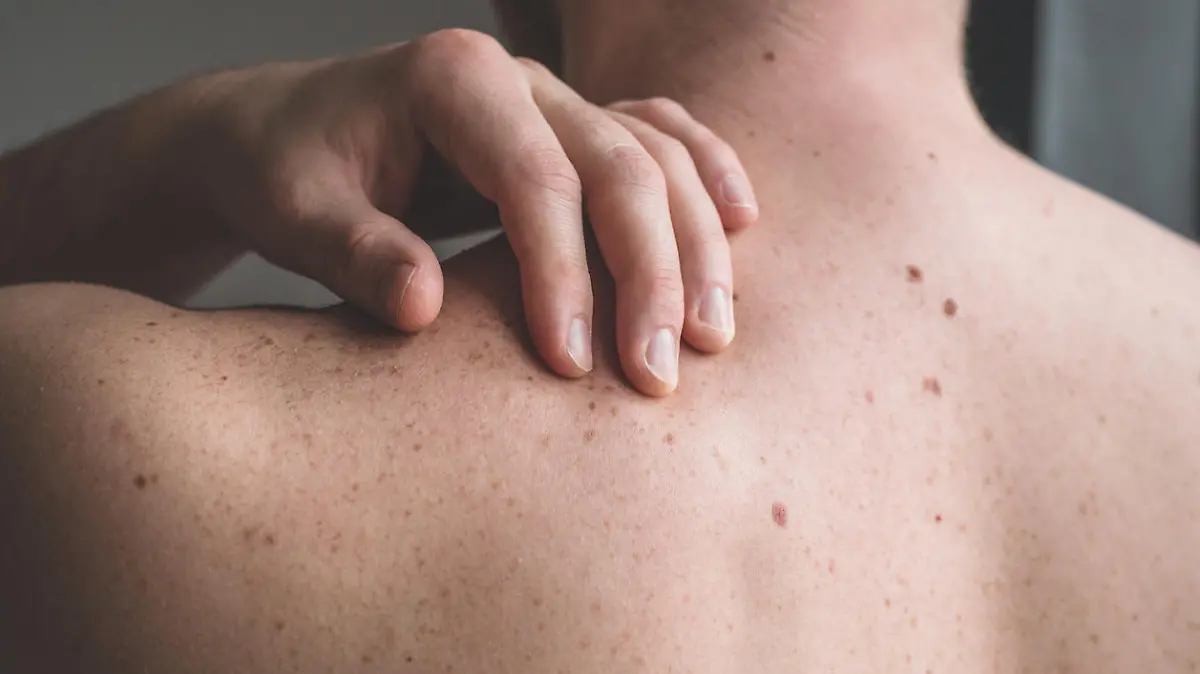 Checking benign moles. Close up detail of the bare skin on a man back with scattered moles and freckles. Sun effect on skin. Birthmarks on skin
