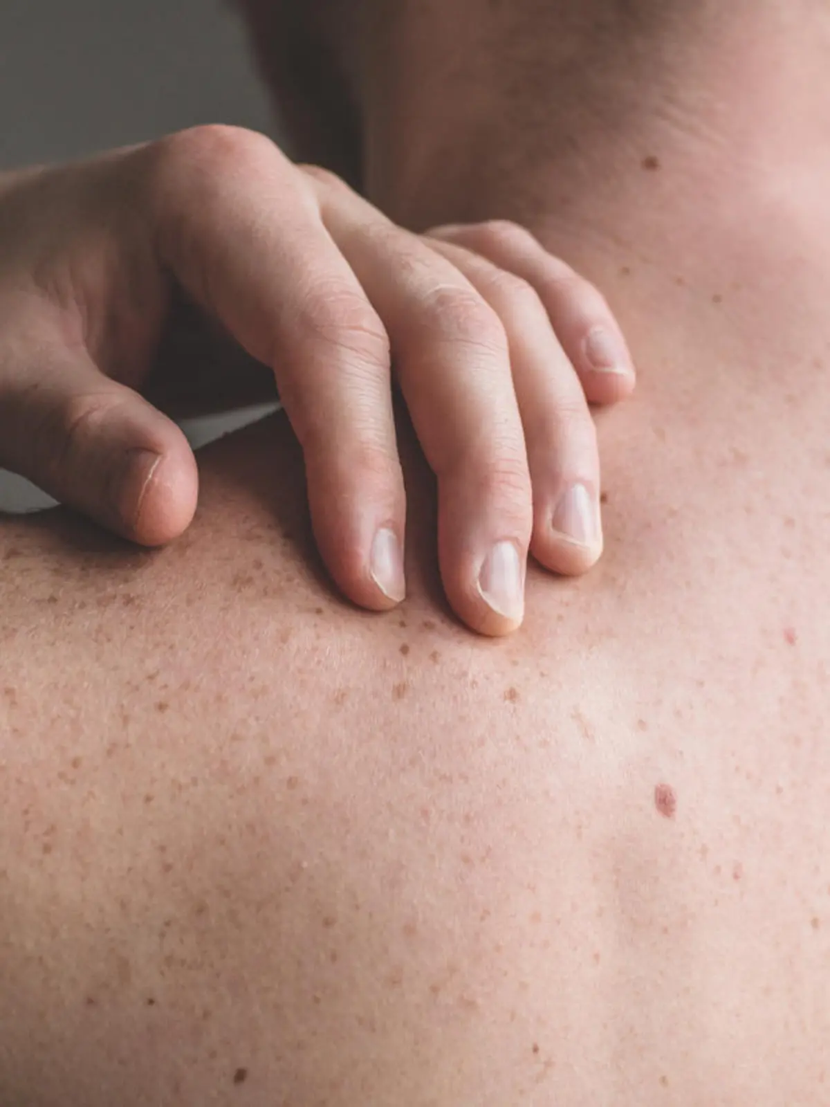 Checking benign moles. Close up detail of the bare skin on a man back with scattered moles and freckles. Sun effect on skin. Birthmarks on skin