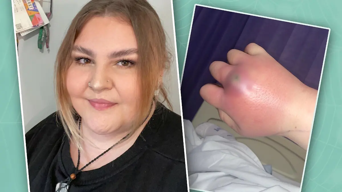 Morgan (21) wachte eines Morgens mit einer juckenden Hand auf - sie wurde im Schlaf von einer Spinne gebissen.