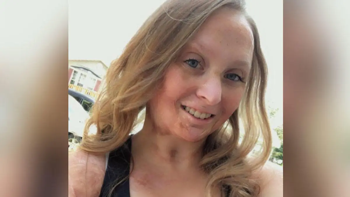 Charity macht jetzt eine Ausbildung zur Krankenschwester für Brandverletzte: "Ich weiß, wie es ist, schwere Verbrennungen zu erleiden, und ich habe das Gefühl, dass ich einen großen Unterschied machen kann."
