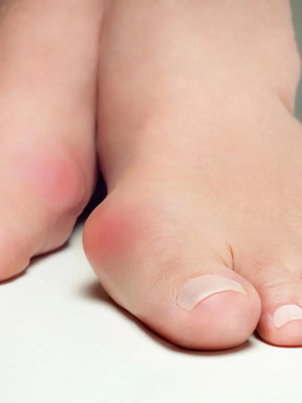 Zwanzig Prozent aller Erwachsenen - also fast 17 Millionen Deutsche - entwickeln im Laufe der Jahre einen Hallux Valgus. Das ist diese etwas unschöne und vor allem sehr schmerzhafte Fußfehlstellung, bei der sich der Fußballen extrem nach außen wölbt. Vor allem Frauen haben damit zu kämpfen. Viele sagen: Die hohen Hacken sind schuld daran. Stimmt aber nicht ganz. Was den sogenannten Hammerzeh wirklich verursacht und was Betroffene tun können, erklärt Dr. Anke Röser, Präsidentin der Gesellschaft für Fuß und Sprunggelenkchirurgie, im Video.