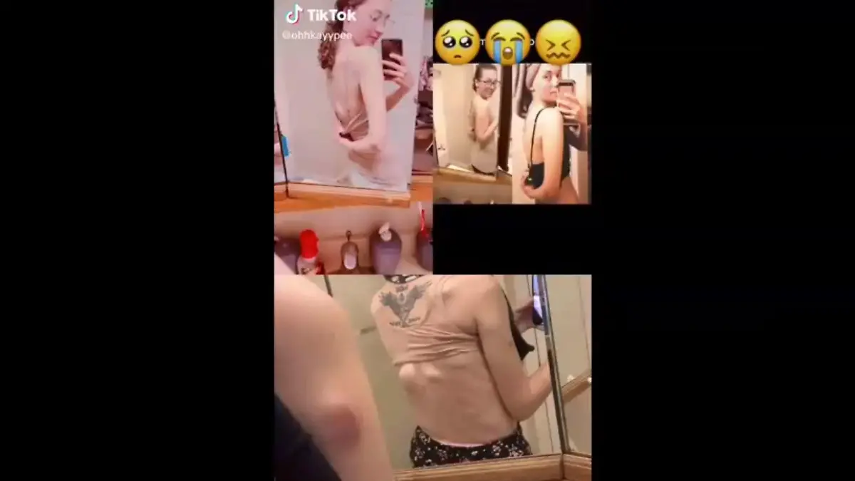 Kassidy Pierson aus Minnesota ist an Hautkrebs gestorben.