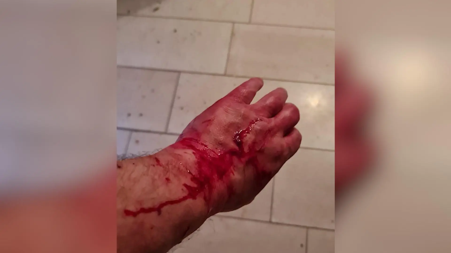 Aufgekratzter Arm von Michael U.