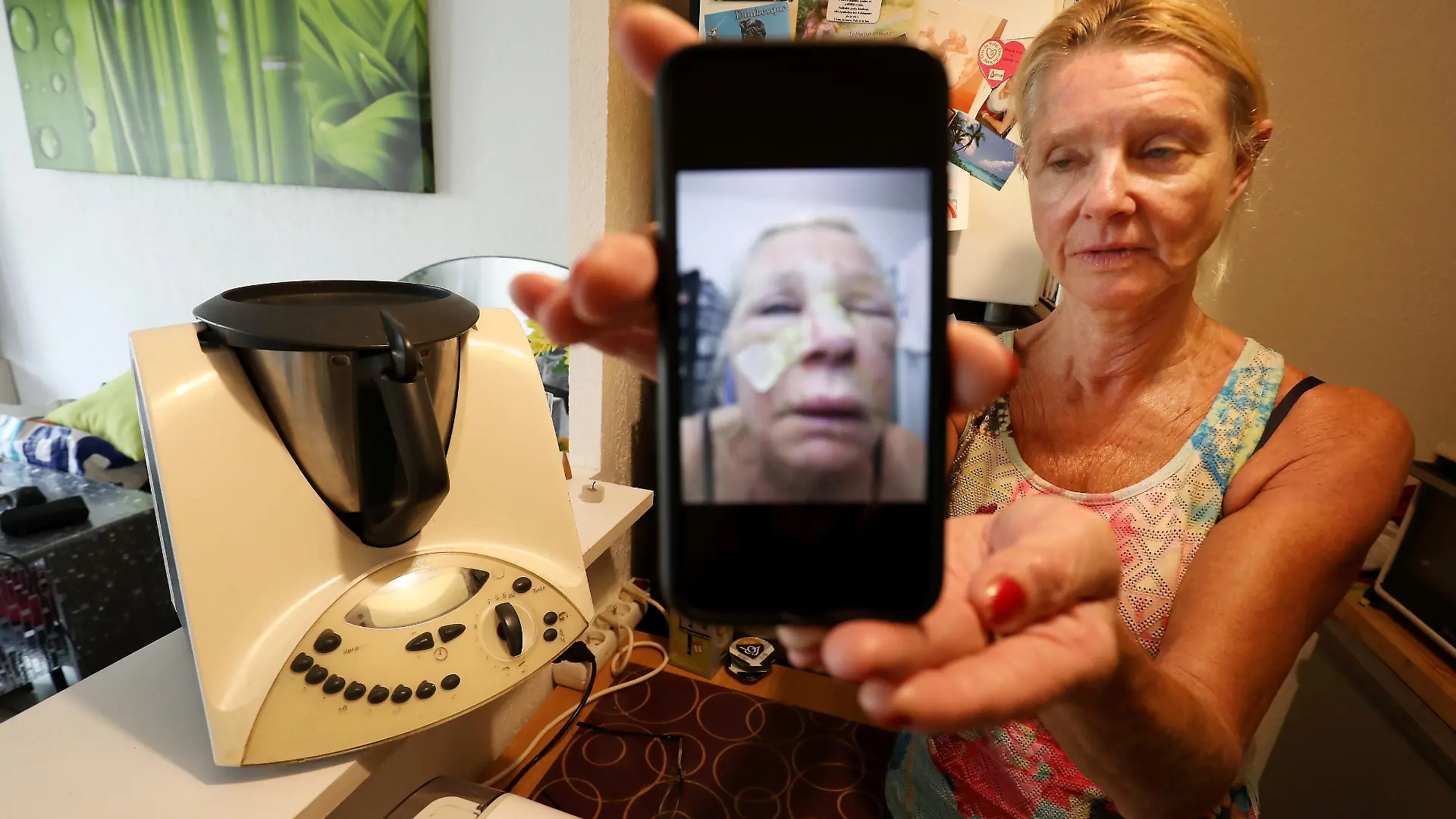 ©PHOTOPQR/NICE MATIN/Philipe Arnassan ; Frejus ; 16/09/2021 ;  Annie VANDENBUSH VICTIME DE SON THERMOMIX QUI LUI A PROJETE SON CONTENU A 100 DEGRES A LA FIGURE
SA SAUCE TOMATE EN PREPARATION EST SORTIE COMME UN GEYSER A TRAVERS LE TROU AU SOMMET DU BOL CUISEUR, LUI OCCASIONNANT DE GRAVES BRULURES (MaxPPP TagID: maxmatinnews500722.jpg) [Photo via MaxPPP]