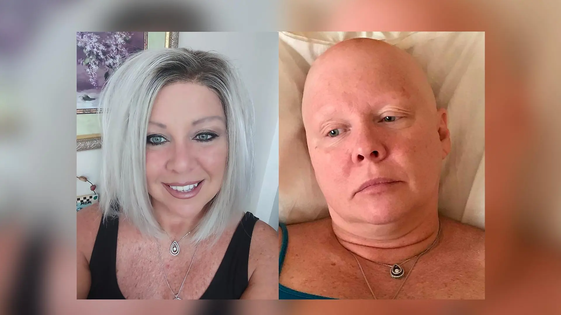 Tamara Dougherty fielen nach einer Brust-OP auf einmal die Haare aus.