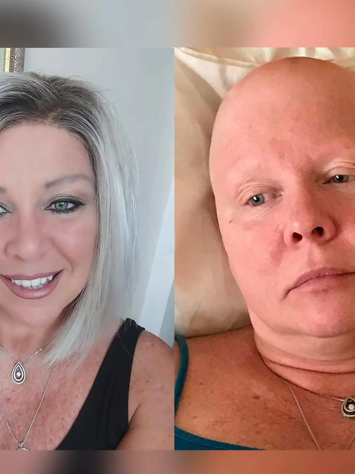 Tamara Dougherty fielen nach einer Brust-OP auf einmal die Haare aus.
