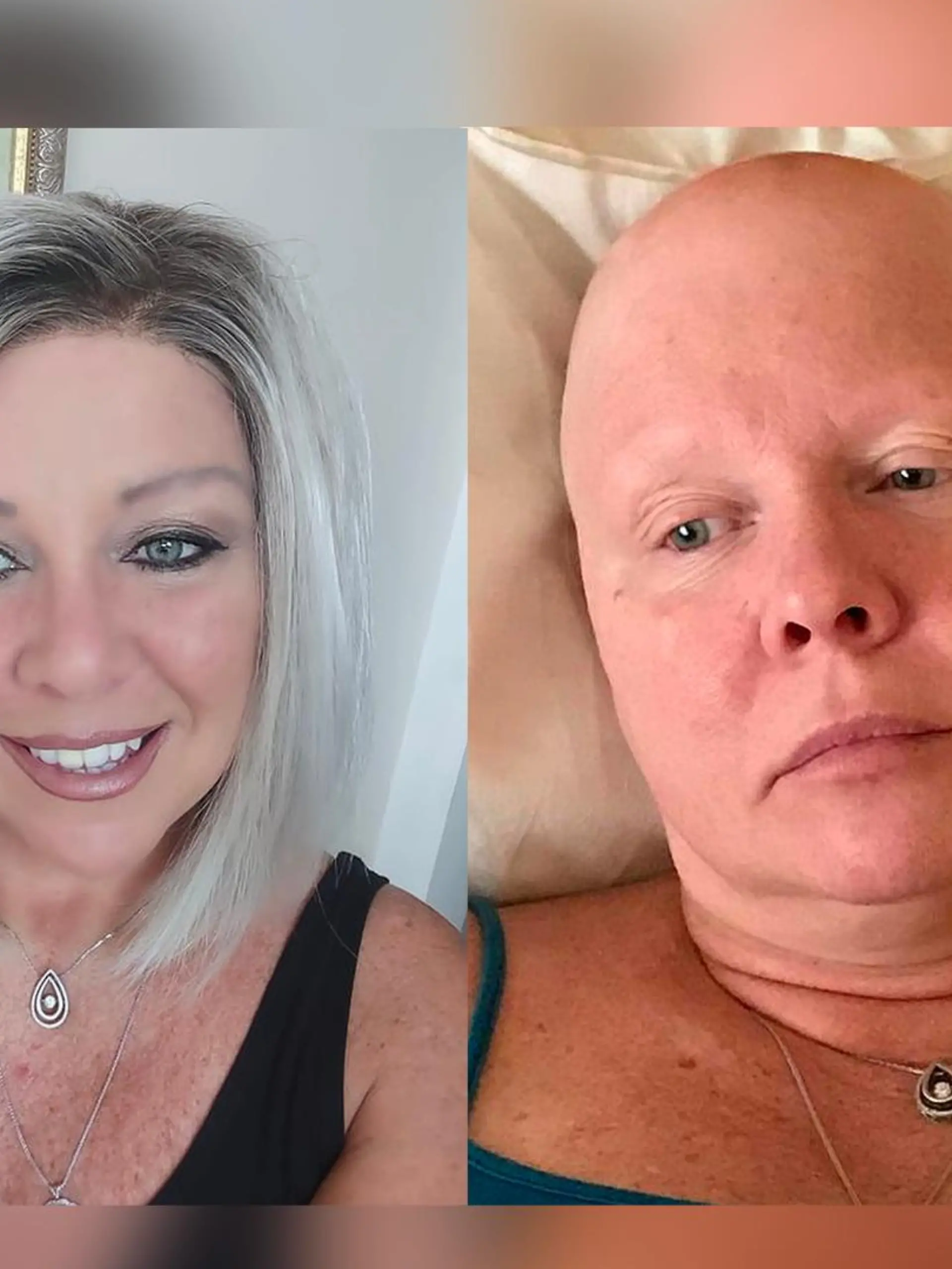 Tamara Dougherty fielen nach einer Brust-OP auf einmal die Haare aus.