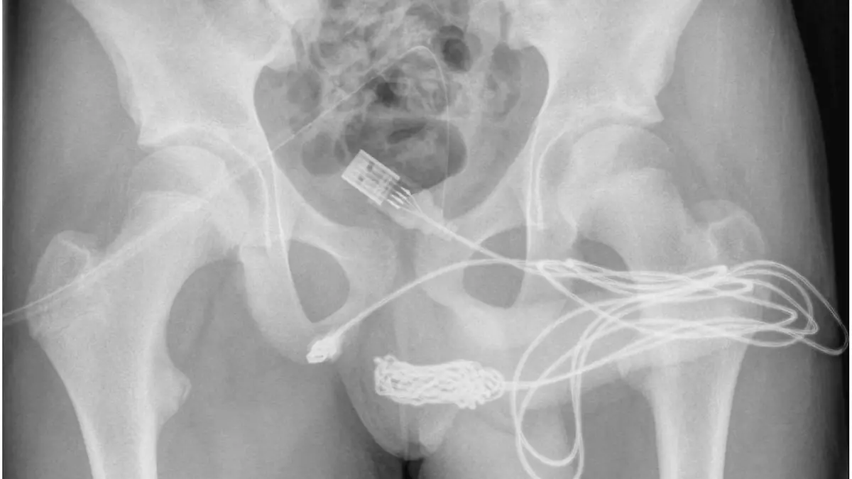 Das Röntgenbild zeigt das USB-Kabel im Penis.