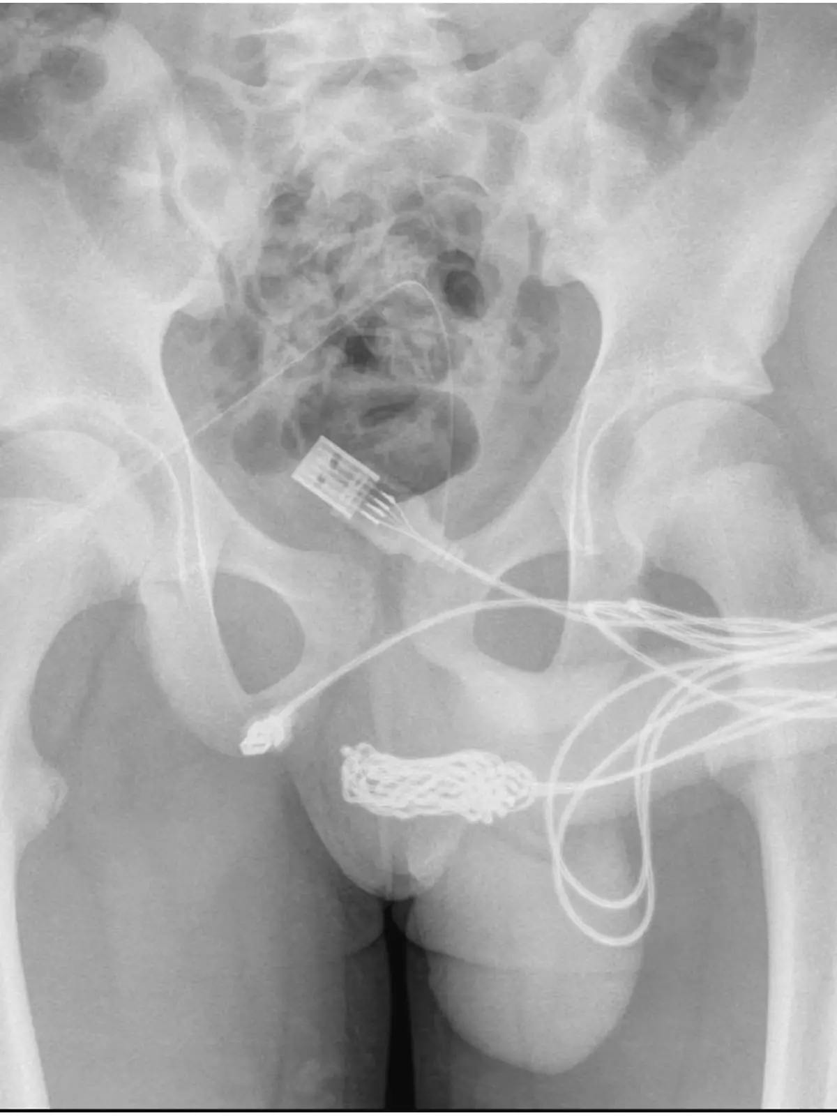 Das Röntgenbild zeigt das USB-Kabel im Penis.