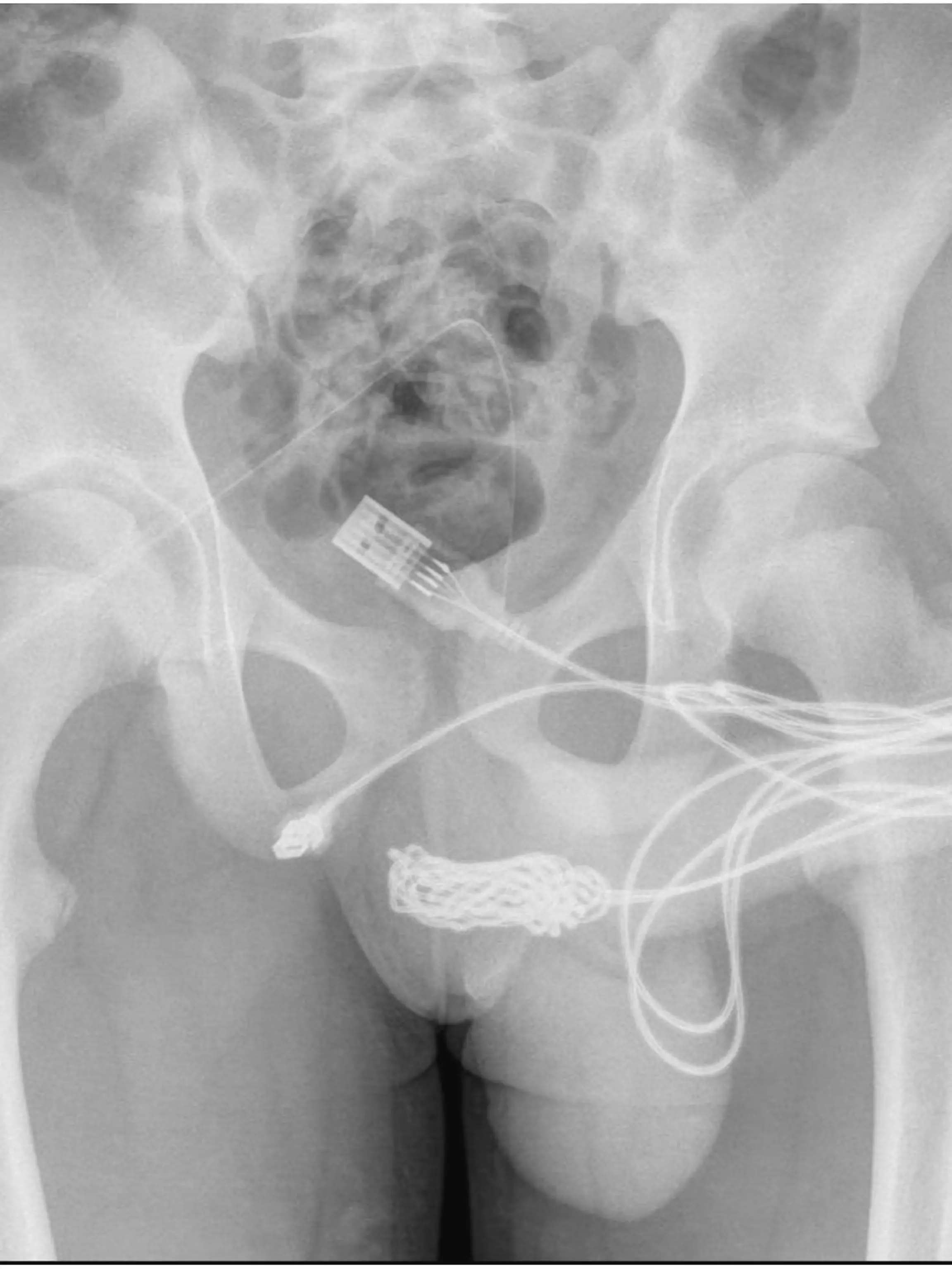 Das Röntgenbild zeigt das USB-Kabel im Penis.