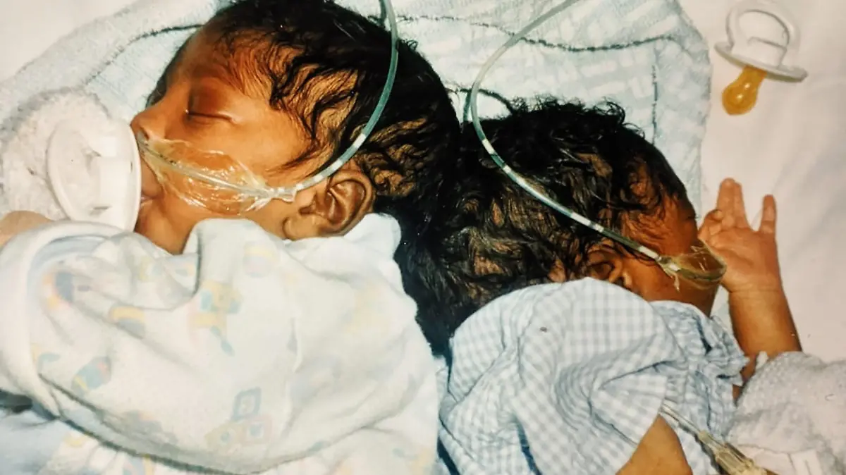 EXKLUSIV - SONDERKONDITIONEN: DOPPELTER ANSTRICH - MINDESTHONORAR 120 EUR EXCLUSIVE
18/09/2021 For Features: Conjoined twins, Sanchia and Eman Mowatt of Birmingham. They were separated in December 2001 after a 16-hour procedure, at Birmingham Children's Hospital - the first time such an operation had been carried out in the UK, and only the third time in the world. COLLECT SHOWS THE TWINS BEFORE THEIR OPERATION. Pic by Paul Tonge. Commissioned by The Sun.