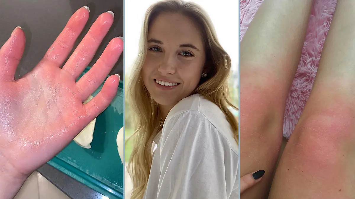 Zuzanna Dmitruk reagiert auf Kälte mit schweren allergischen Reaktionen.