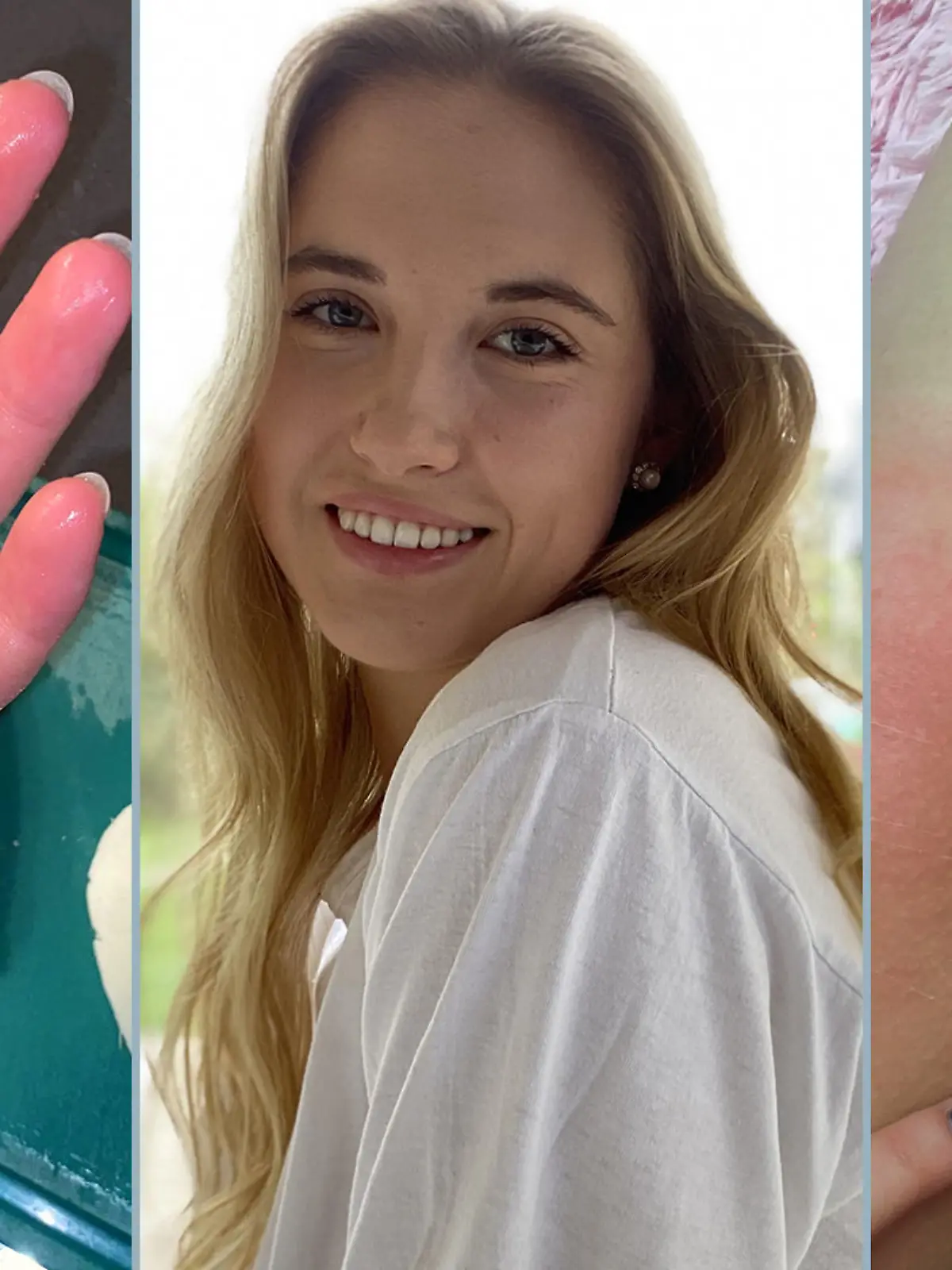 Zuzanna Dmitruk reagiert auf Kälte mit schweren allergischen Reaktionen.