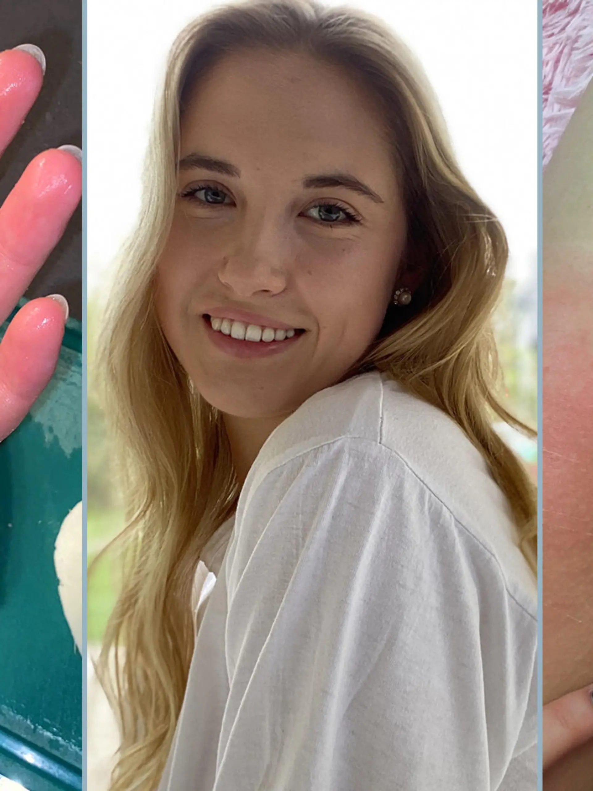 Zuzanna Dmitruk reagiert auf Kälte mit schweren allergischen Reaktionen.