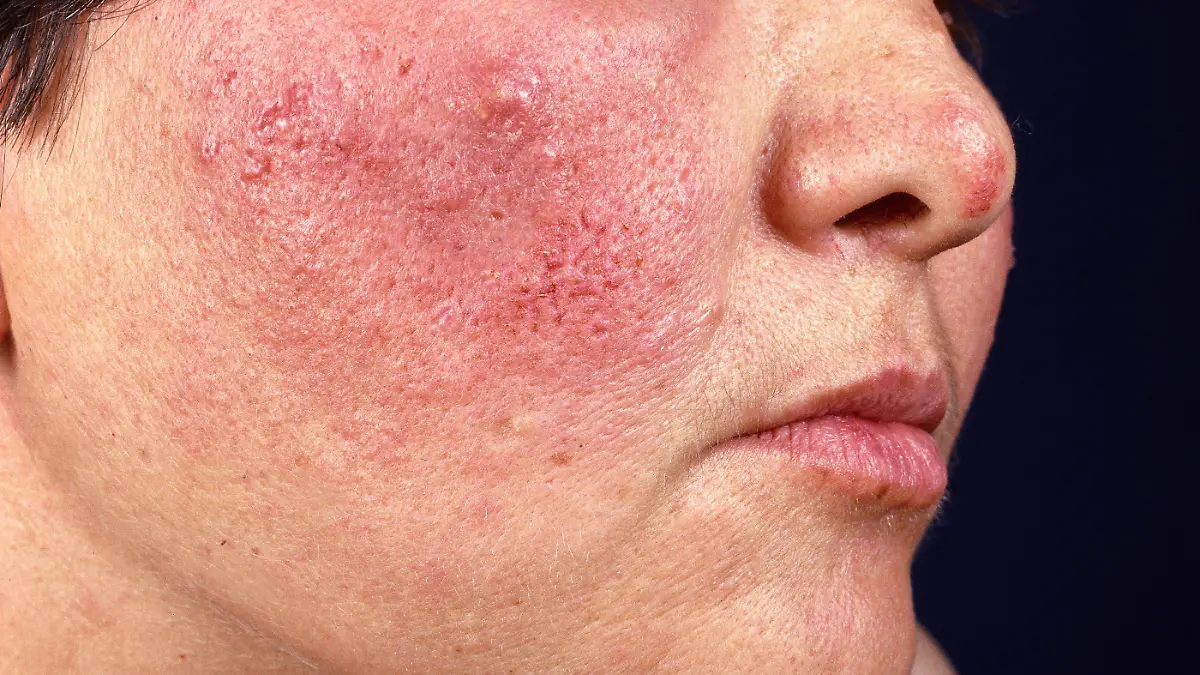 Dermatologie Medizin Krankheit der Talgdrüsen Rosacea Haut Rötung und Knötchenbildung auf Wange von Patientin medicine dermatology rosacea WA Rhinophym