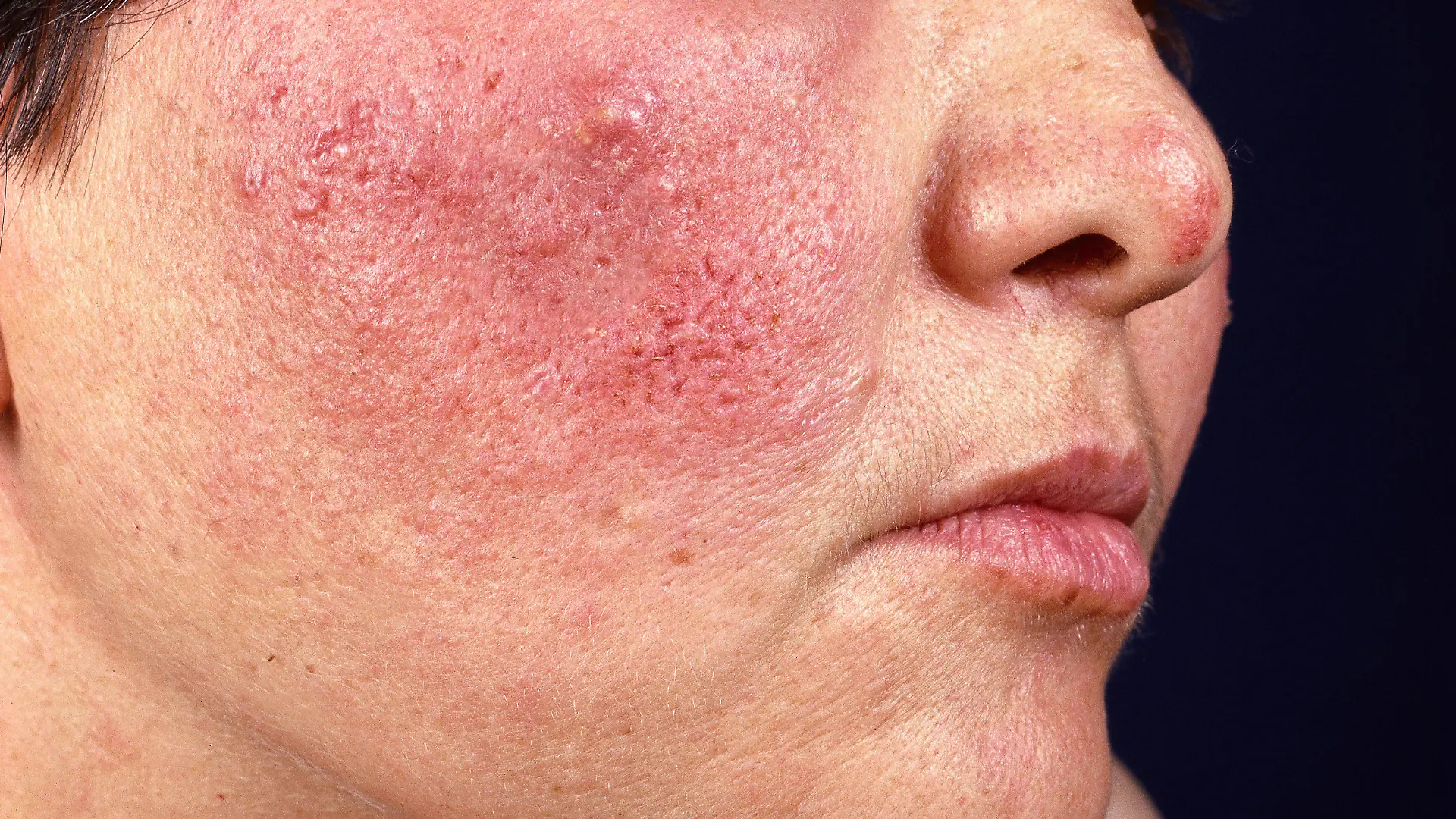 Dermatologie Medizin Krankheit der Talgdrüsen Rosacea Haut Rötung und Knötchenbildung auf Wange von Patientin medicine dermatology rosacea WA Rhinophym