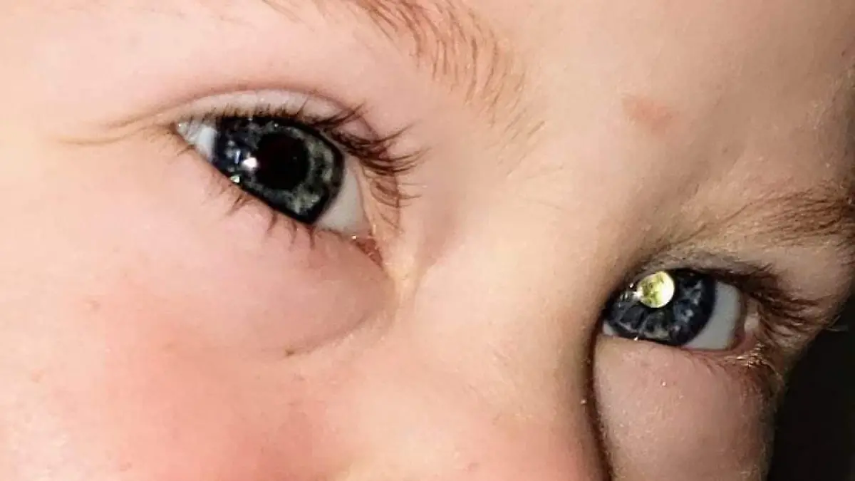 Story from Jam Press (Eye Cancer Caught)
Pictured: Picture of Ryder where glow is visible in his eye.
Mum spots baby son's rare EYE CANCER after seeing strange white glow in photos – now warns fellow mums to watch out for signs
A baby has been diagnosed with eye cancer after his mum spotted a strange white glow in his eyes in photos.
Andrea Temarantz, 42, from Arizona, US, is mum to five-year-old Ryder, who also has Down’s syndrome.
As her son became more active as a baby, Andrea found herself snapping more images of her playful boy and his daily antics.
However, when he was around three months old, she noticed a strange white glow in his left eye, captured in the snaps.
Initially, the mum thought it was her faulty phone camera, so she asked her husband, Joey, to get her a better one.
But the glow remained and became even more prominent in the photos, so she decided to mention it to their family doctor.
“He was awake more and he was more active, I was always taking pictures," Andrea, who also has a second son, Joseph, told Jam Press.
“That's when I noticed a white glow, I didn't think much of it.
“I figured it was just because my camera phone wasn't that great.
“However, it was always there. So, I asked my husband to get me a real camera.
“He bought me a Nikon and gave it to me as an early Christmas present.
“I opened it and took pictures right away but to my surprise that glow was even worse.”
In January 2016, Ryder was referred to two specialists and doctors delivered devastating news to his mum, as they said the glow appeared to be a tumour.
Andrea was overwhelmed by emotion and rang her husband to deliver the horrific news.
She said: “As my eyes filled with tears I asked if it was cancer.
“The doctor said he would refer me to another specialist on the same day.
“I called my husband from the parking lot crying.
“I told him I was pretty sure something was really wrong and he needed to meet