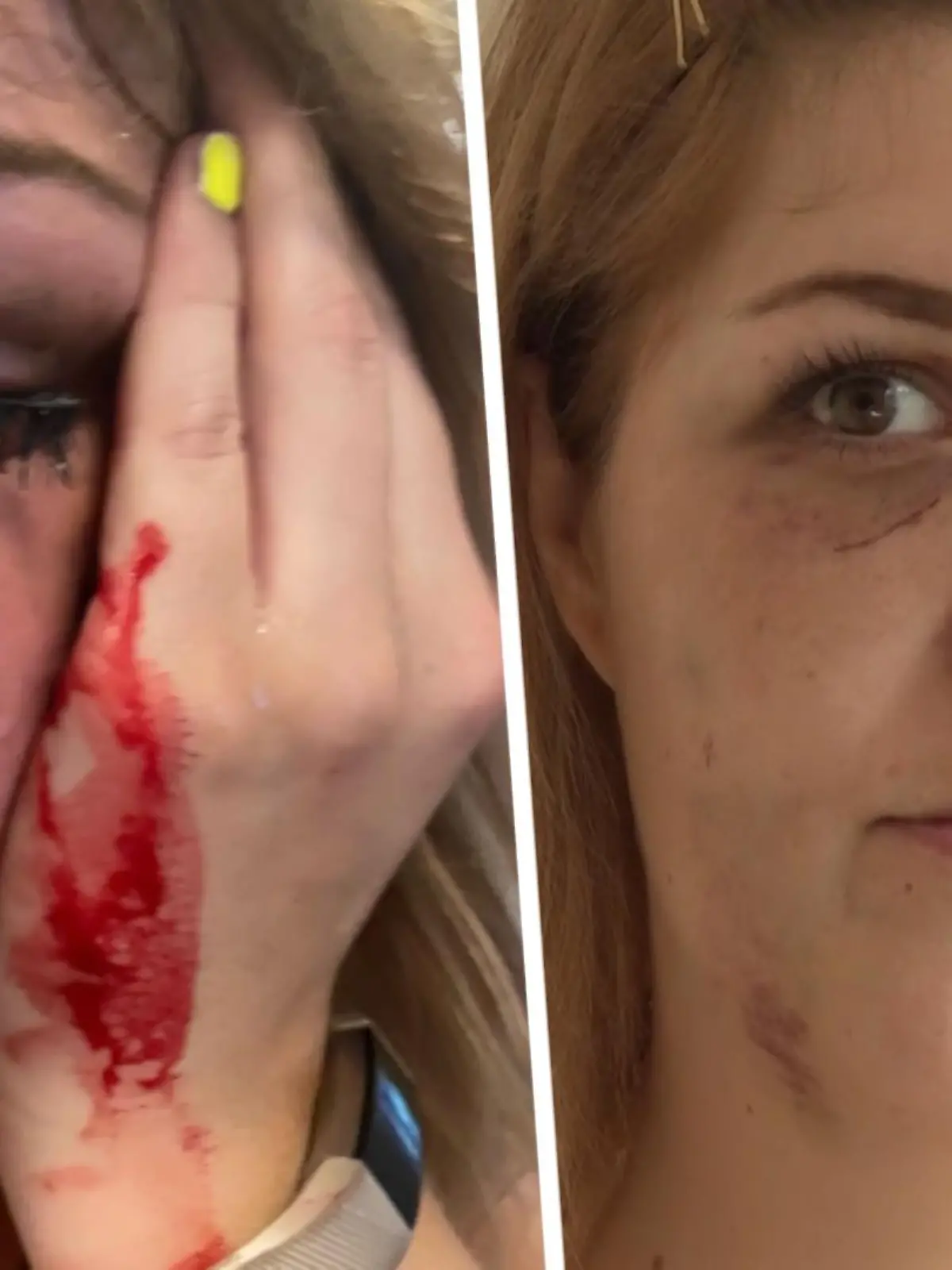 Sarahs Gesicht ist immer noch geschwollen, hinter ihr liegen Tage der Angst und der Schmerzen. Nach anderthalb Jahren Corona-Pause war die 28-Jährige erstmals wieder in einer Disco feiern. Doch der Partyabend endet für sie im Krankenhaus.