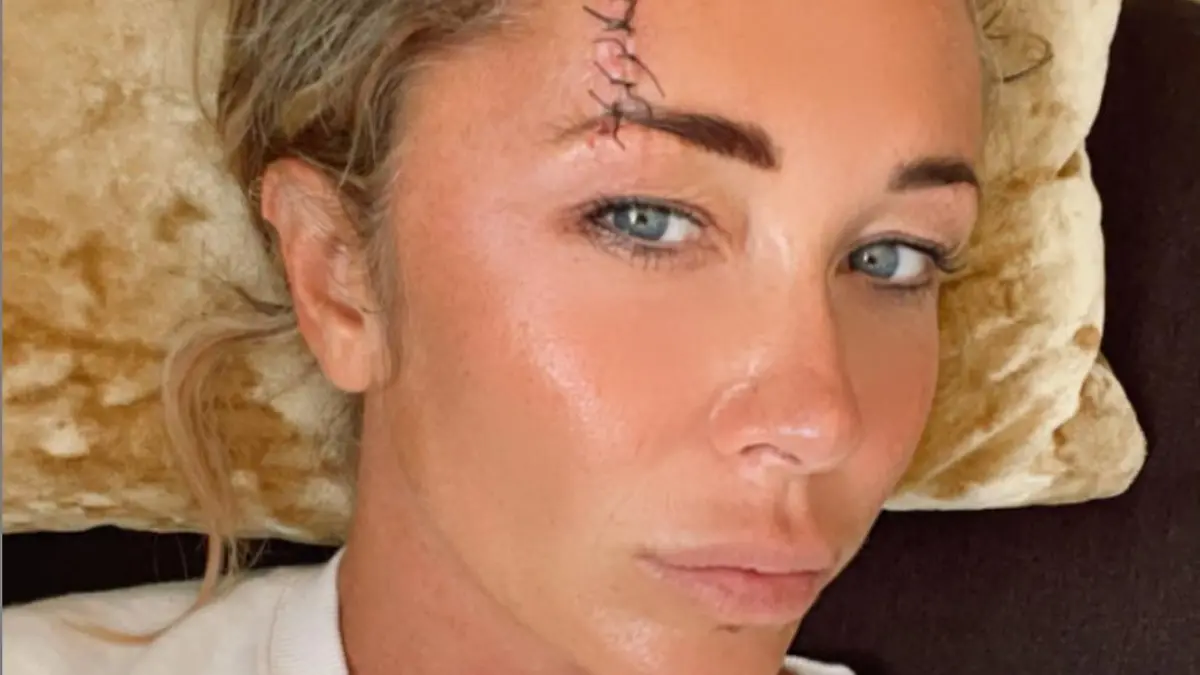 Jenny Frost zeigt fiese Kopfwunde.