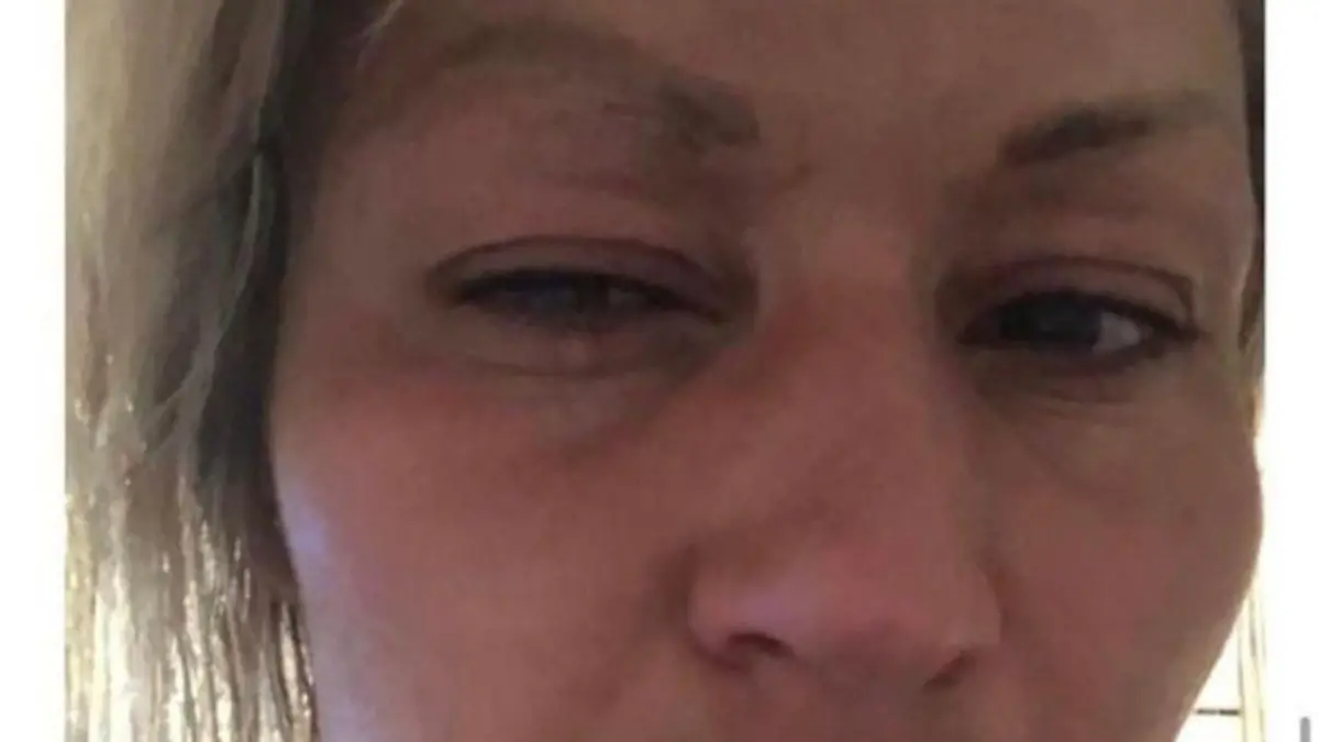 Jasmin Herren mit blauem Auge.